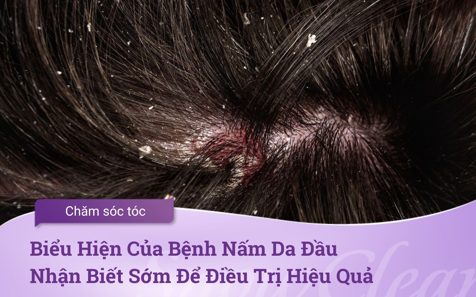Biểu Hiện Của Bệnh Nấm Da Đầu Nhận Biết Sớm Để Điều Trị Hiệu Quả