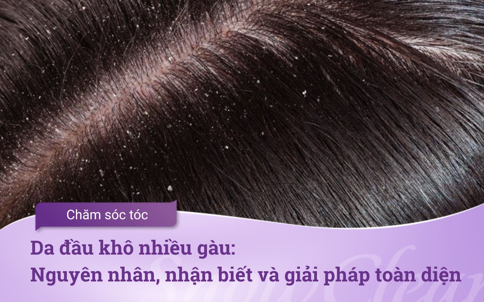 Da đầu khô nhiều gàu Nguyên nhân, nhận biết và giải pháp toàn diện
