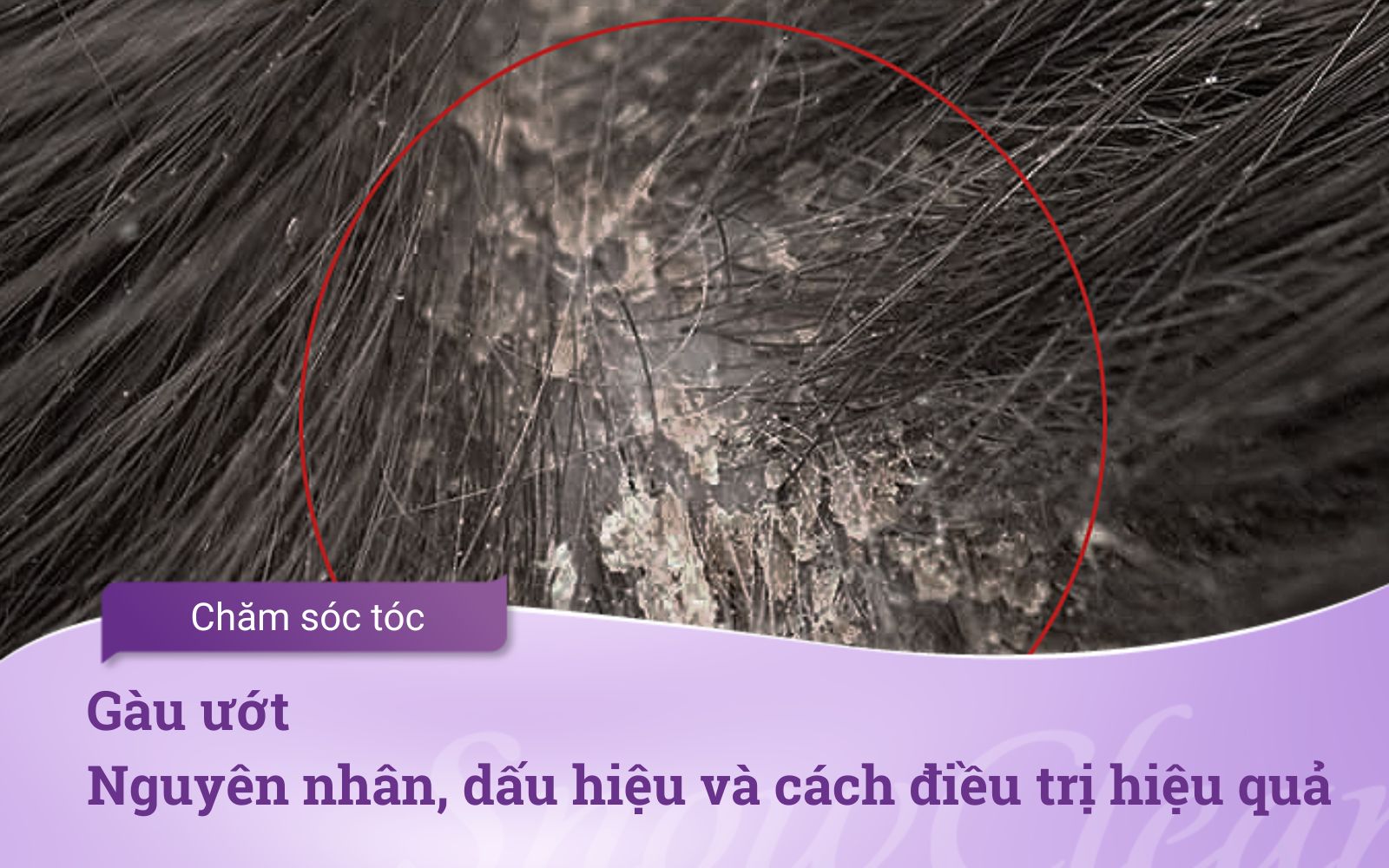 Gàu ướt Nguyên nhân, dấu hiệu và cách điều trị hiệu quả