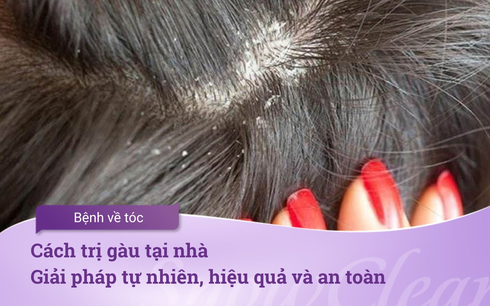 Cách trị gàu tại nhà Giải pháp tự nhiên, hiệu quả và an toàn
