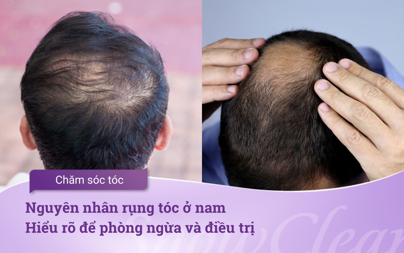 Nguyên nhân rụng tóc ở nam Hiểu rõ để phòng ngừa và điều trị