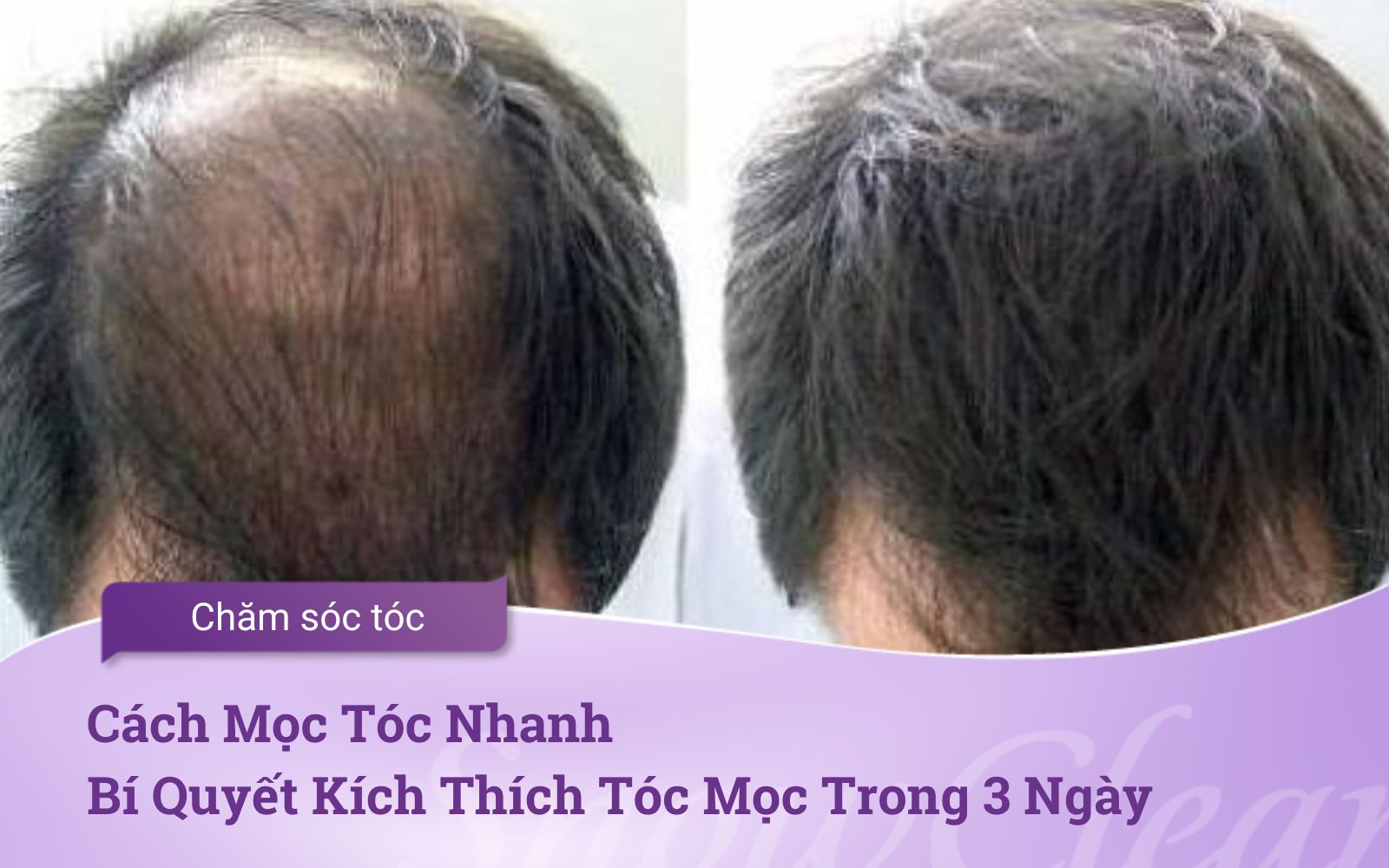 Cách Mọc Tóc Nhanh Bí Quyết Kích Thích Tóc Mọc Trong 3 Ngày