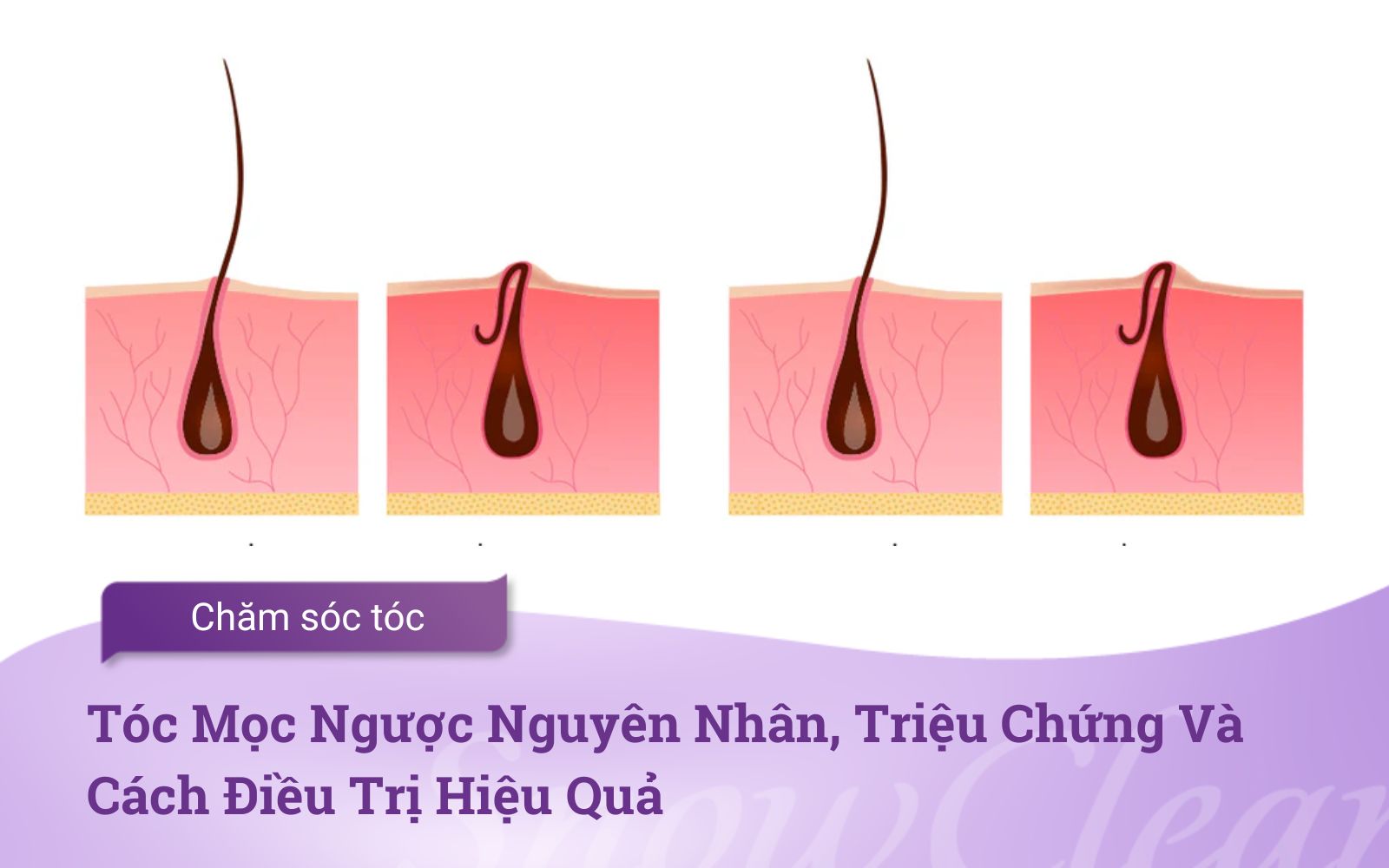 Tóc Mọc Ngược Nguyên Nhân, Triệu Chứng Và Cách Điều Trị Hiệu Quả