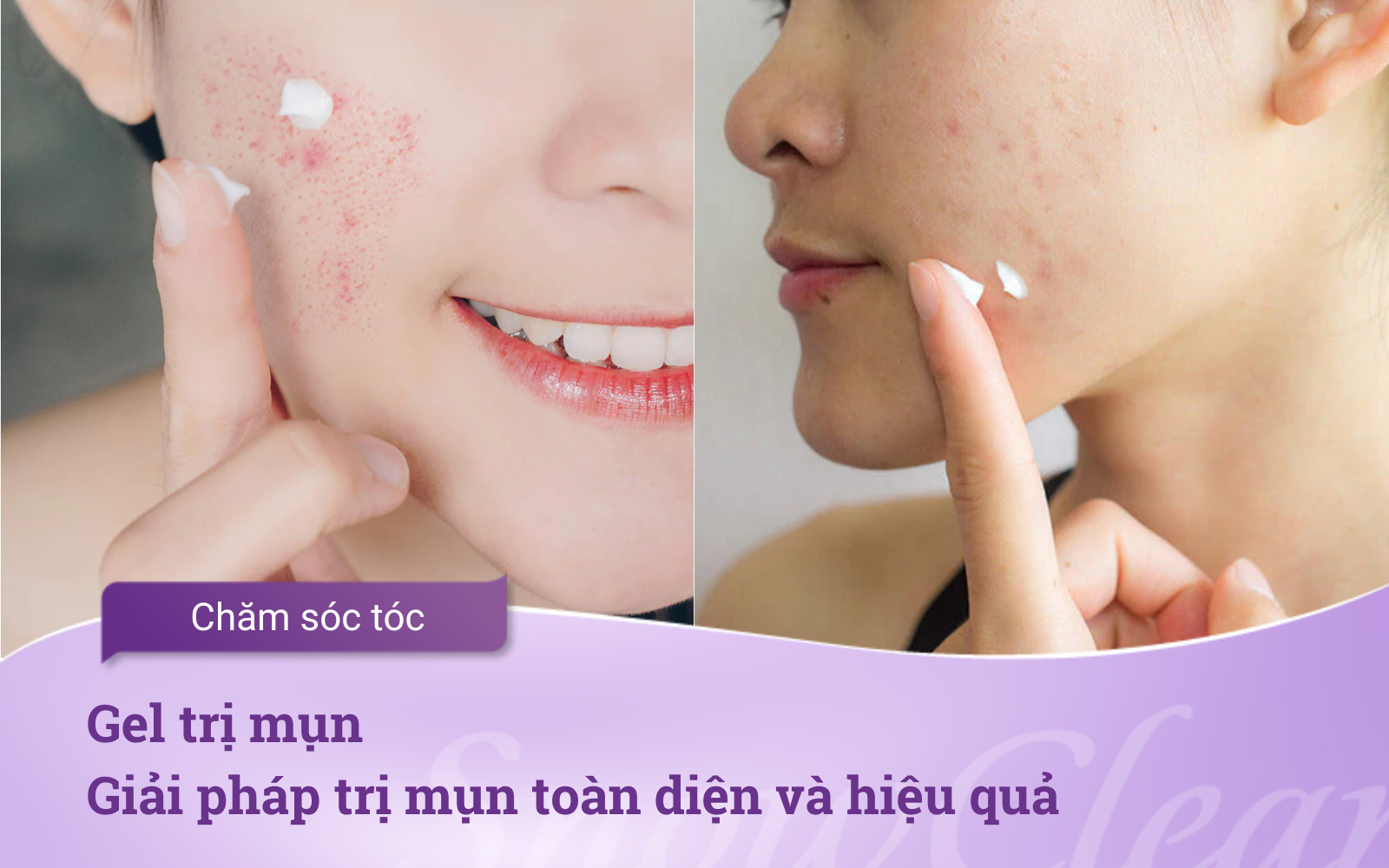 Gel trị mụn Giải pháp trị mụn toàn diện và hiệu quả