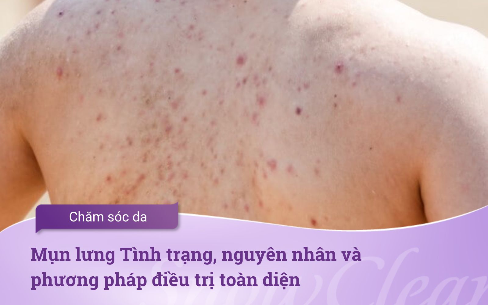 Mụn lưng Tình trạng, nguyên nhân và phương pháp điều trị toàn diện