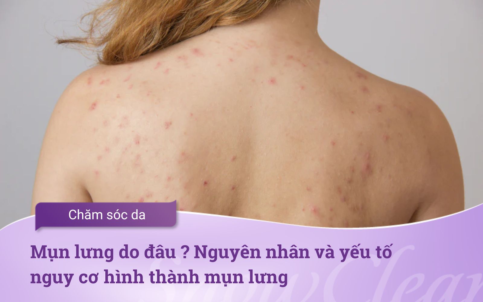 Mụn lưng do đâu? Nguyên nhân và yếu tố nguy cơ hình thành mụn lưng