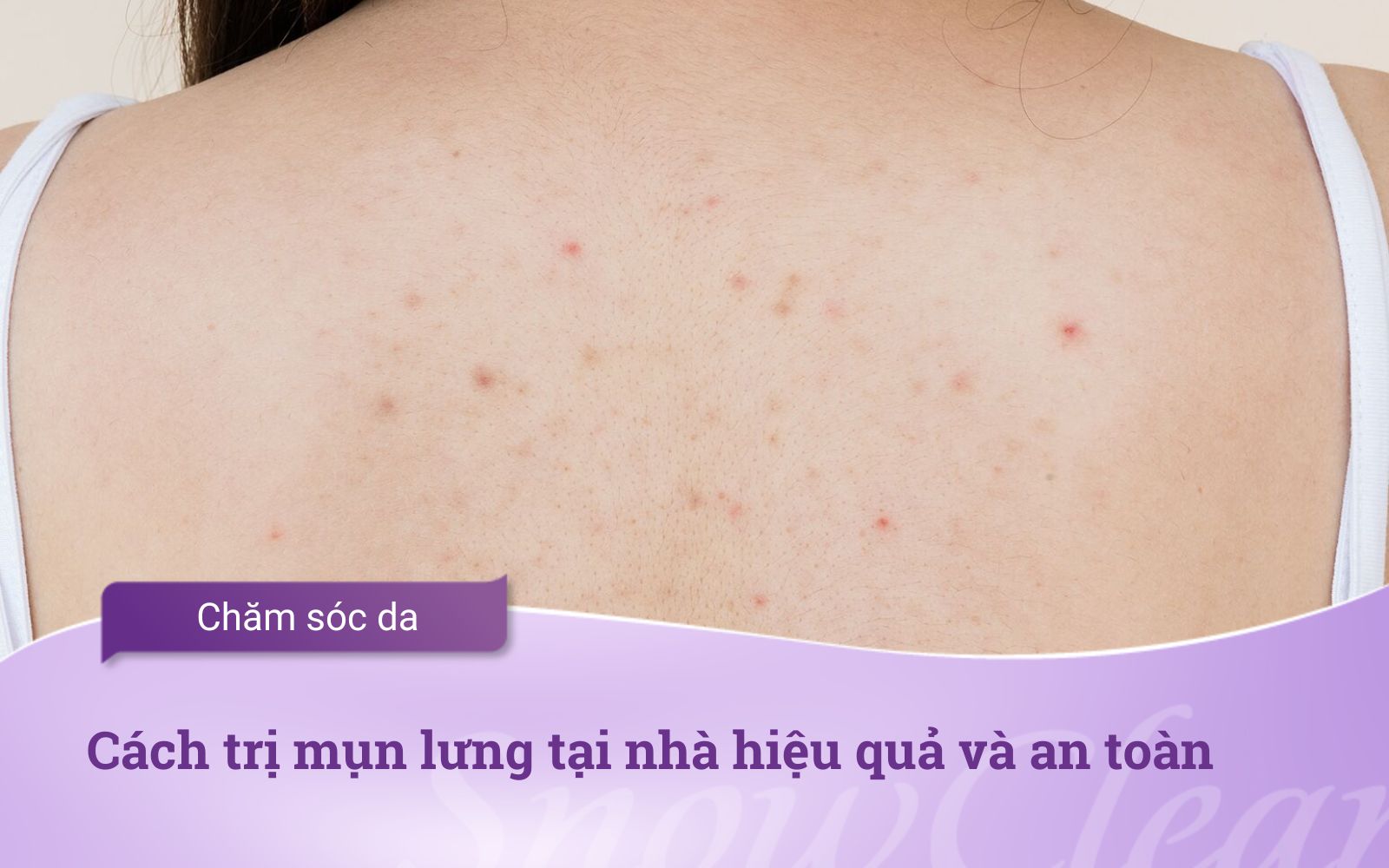 Cách trị mụn lưng tại nhà hiệu quả và an toàn