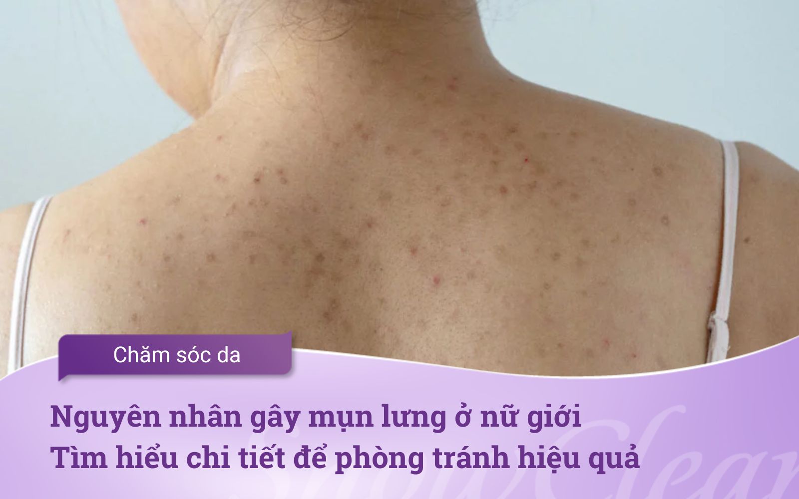 Nguyên nhân gây mụn lưng ở nữ giới Tìm hiểu chi tiết để phòng tránh hiệu quả