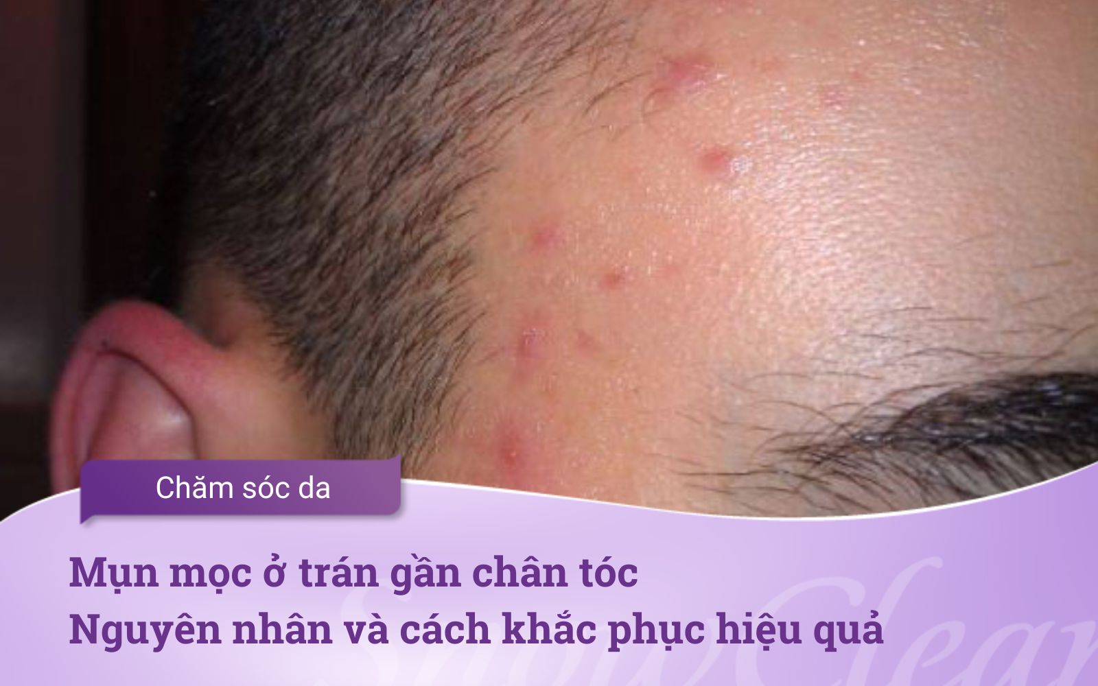 Mụn mọc ở trán gần chân tóc Nguyên nhân và cách khắc phục hiệu quả