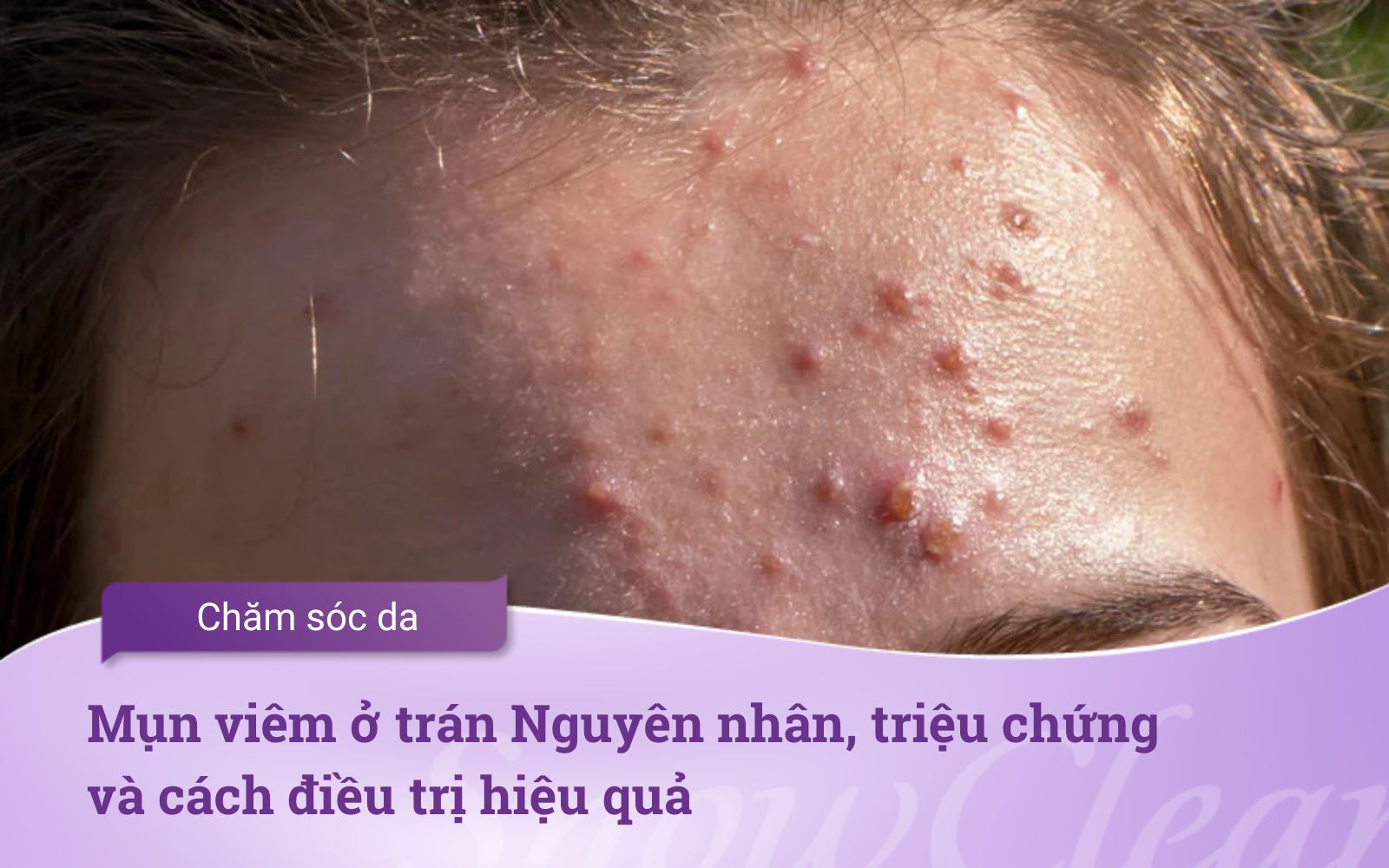 Mụn viêm ở trán Nguyên nhân, triệu chứng và cách điều trị hiệu quả