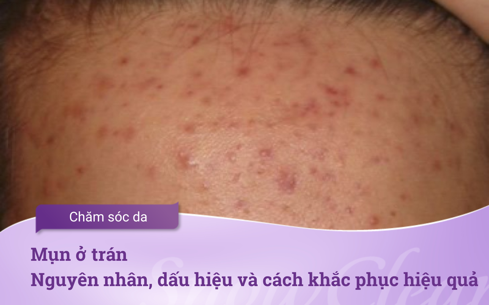 Mụn ở trán Nguyên nhân, dấu hiệu và cách khắc phục hiệu quả