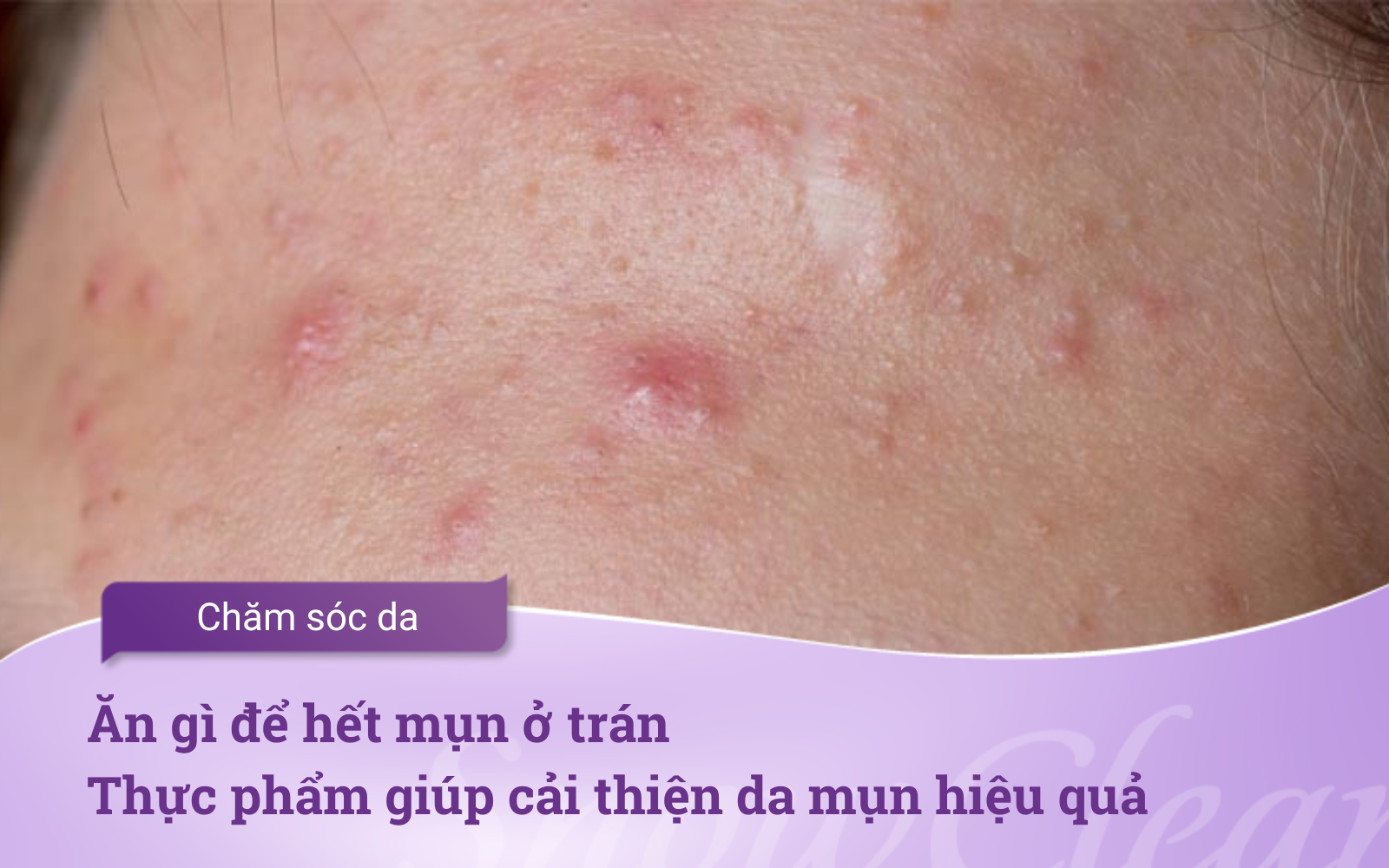 Ăn gì để hết mụn ở trán? Thực phẩm giúp cải thiện da mụn hiệu quả