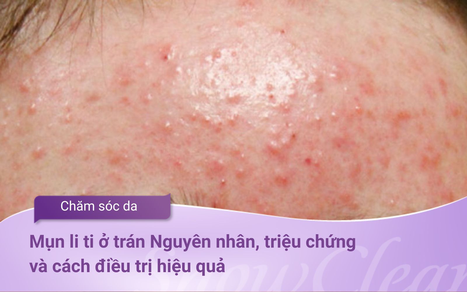Mụn li ti ở trán Nguyên nhân, triệu chứng và cách điều trị hiệu quả