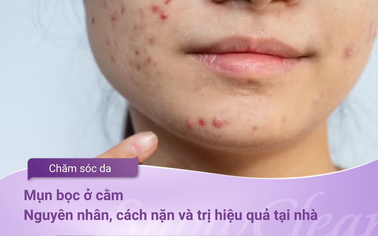Mụn bọc ở cằm Nguyên nhân, cách nặn và trị hiệu quả tại nhà