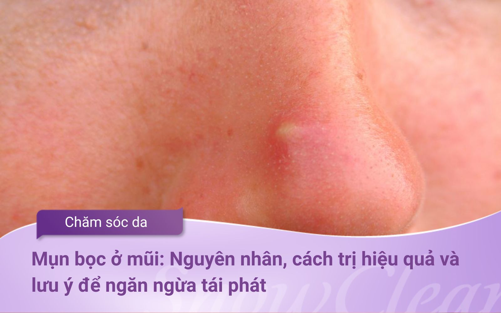 Mụn bọc ở mũi Nguyên nhân, cách trị hiệu quả và lưu ý để ngăn ngừa tái phát