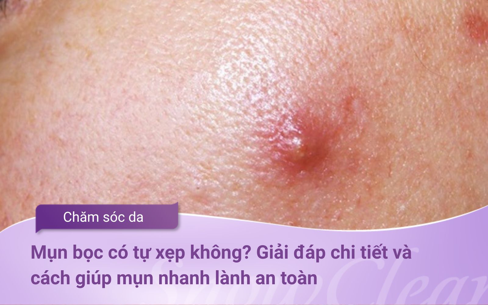 Mụn bọc có tự xẹp không? Giải đáp chi tiết và cách giúp mụn nhanh lành an toàn