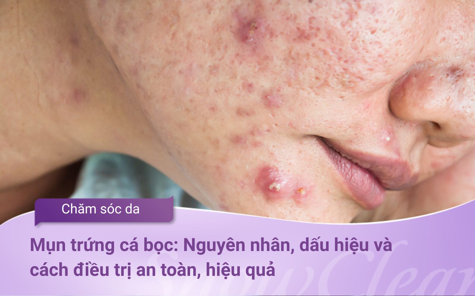 Mụn trứng cá bọc Nguyên nhân, dấu hiệu và cách điều trị an toàn, hiệu quả