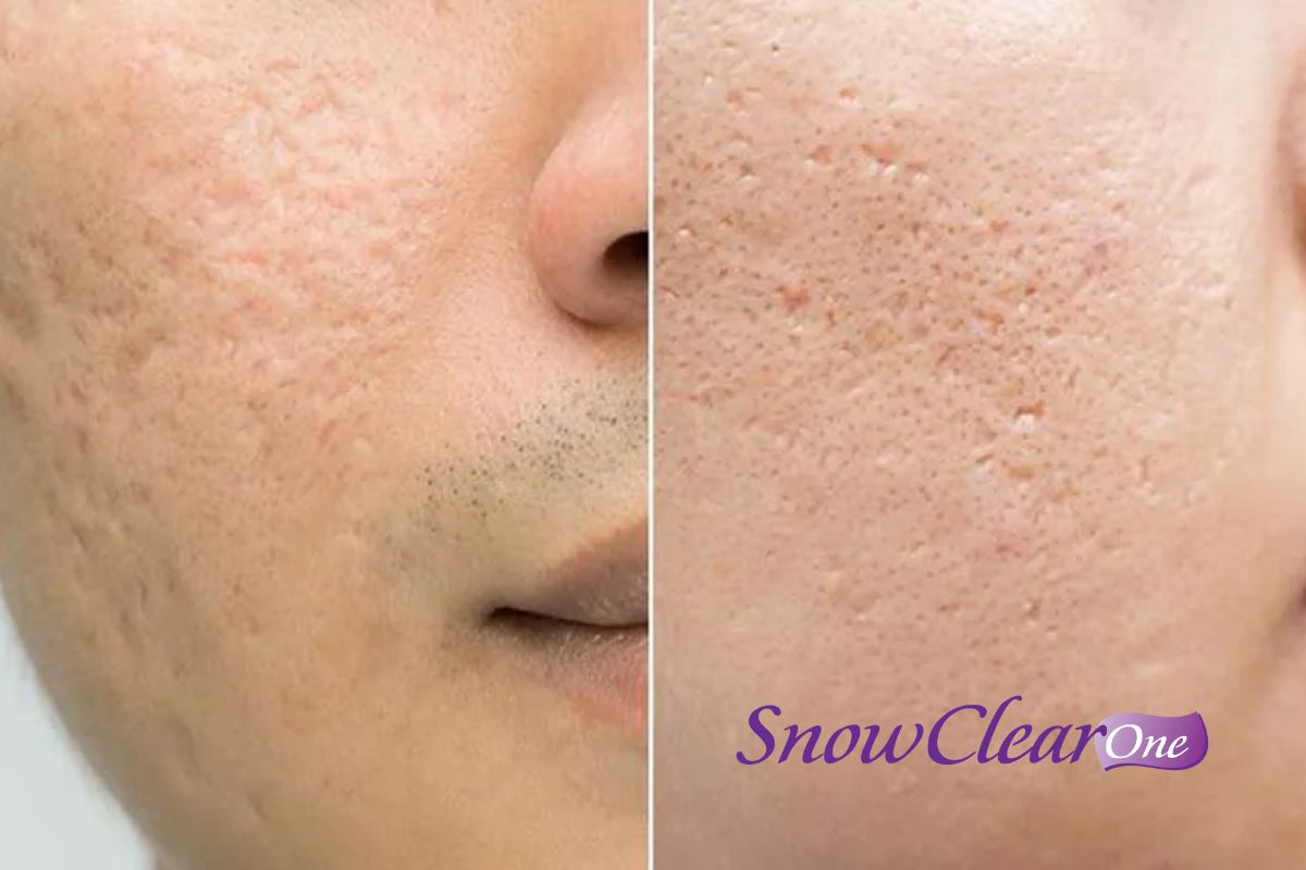 Sẹo lõm, sẹo rỗ