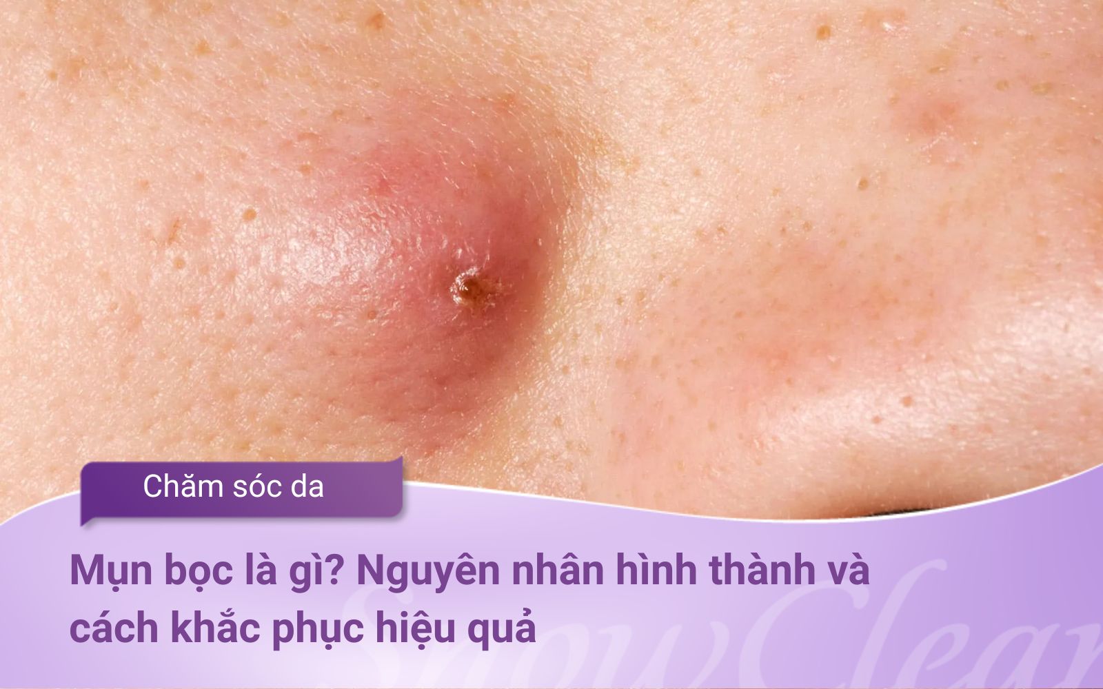 Mụn bọc là gì? Nguyên nhân hình thành và cách khắc phục hiệu quả