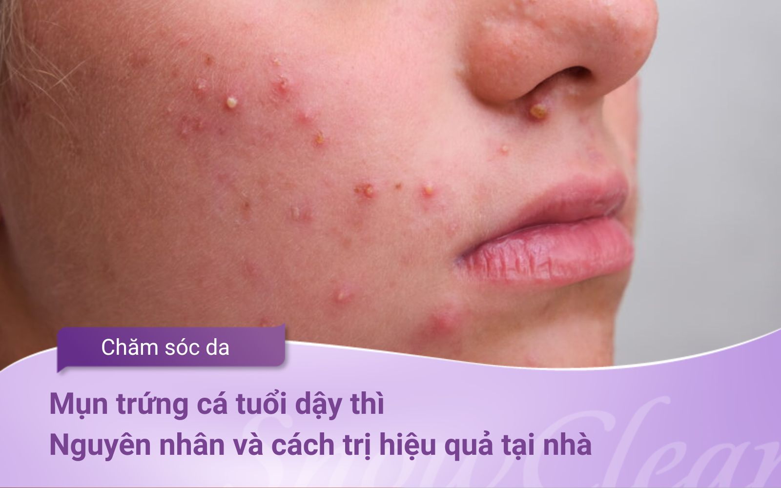 Mụn trứng cá tuổi dậy thì Nguyên nhân và cách trị hiệu quả tại nhà