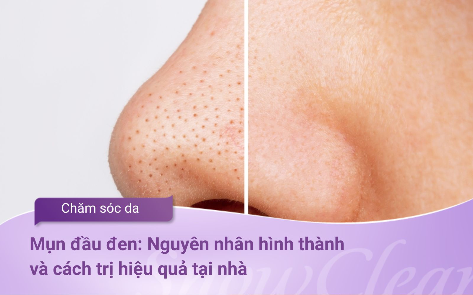 Mụn đầu đen Nguyên nhân hình thành và cách trị hiệu quả tại nhà