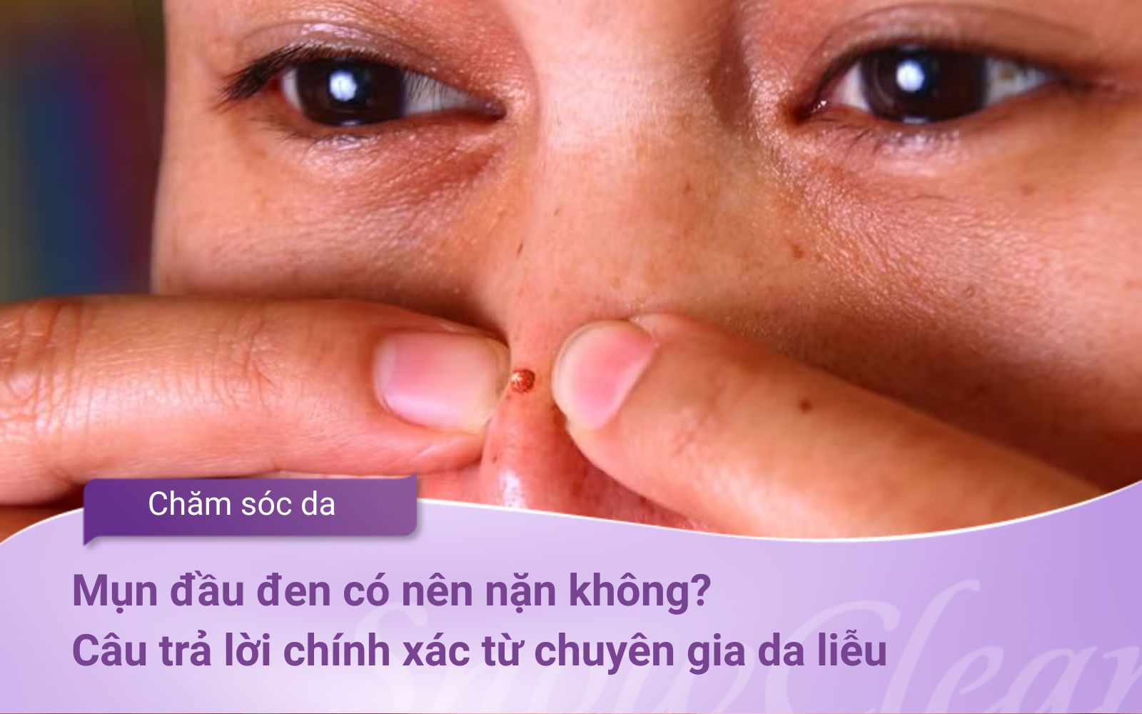 Mụn đầu đen có nên nặn không? Câu trả lời chính xác từ chuyên gia da liễu