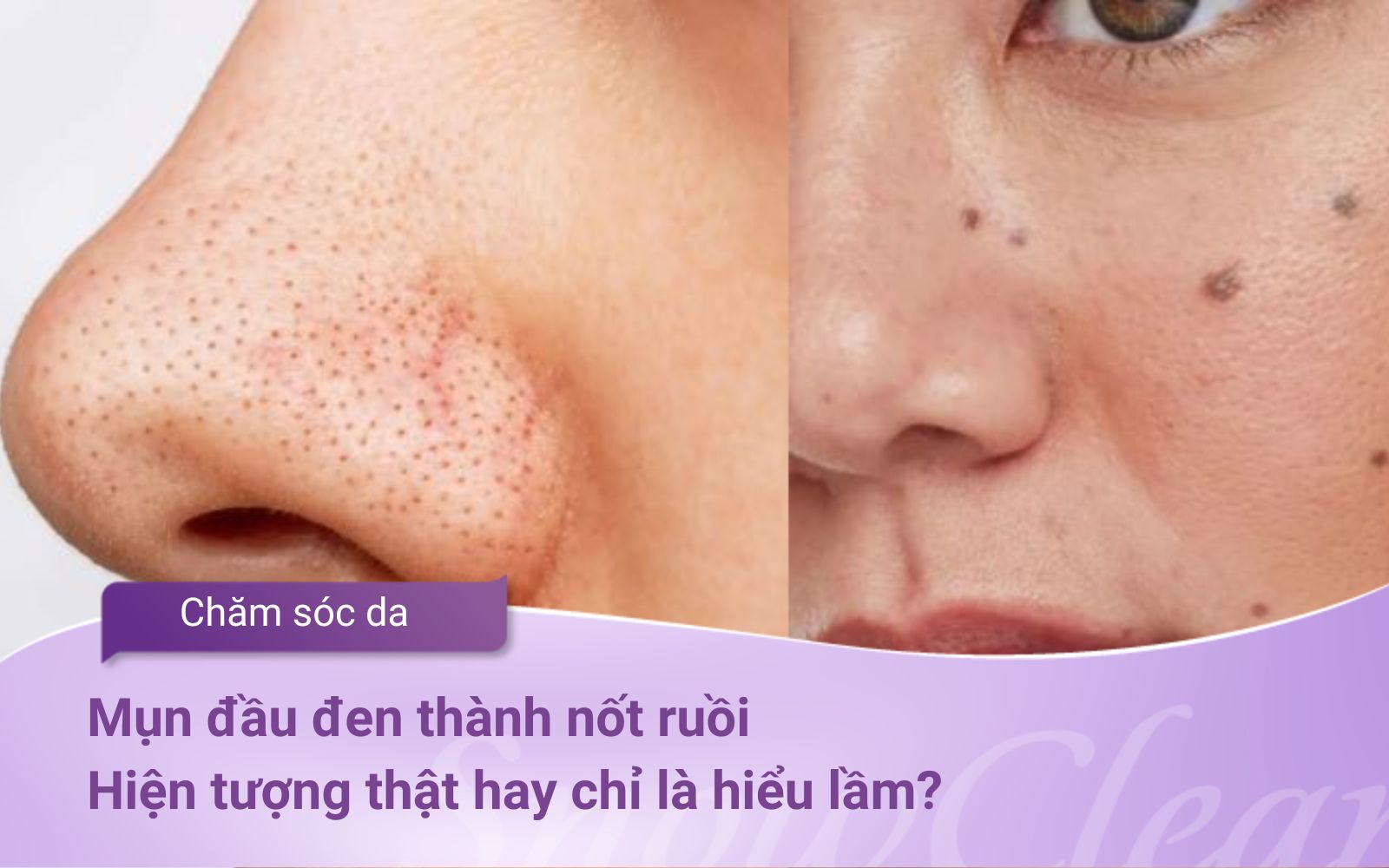 Mụn đầu đen thành nốt ruồi: Hiện tượng thật hay chỉ là hiểu lầm?