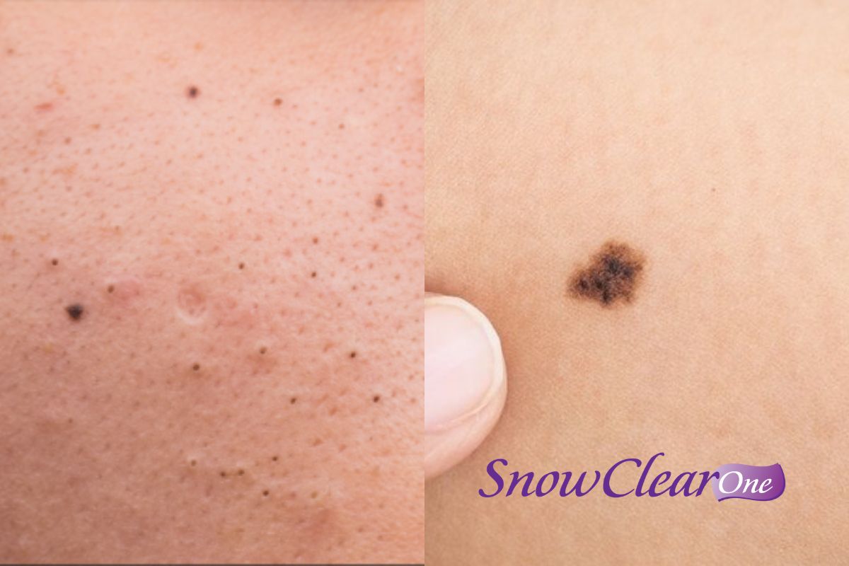 Phân biệt mụn đầu đen và nốt ruồi