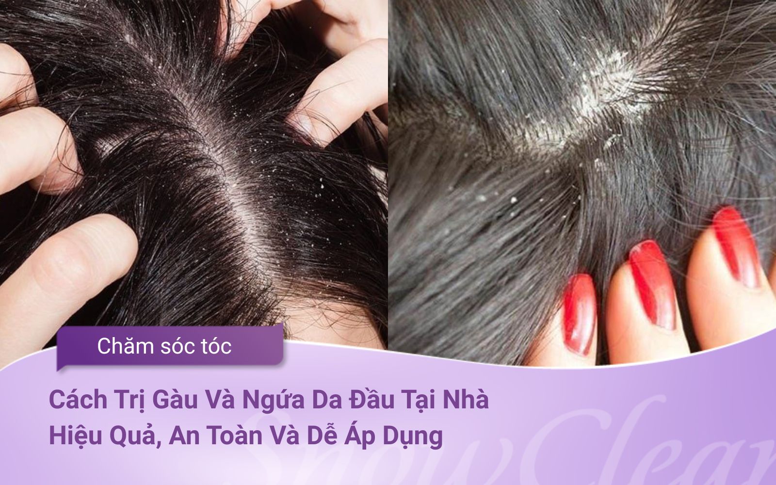 Cách Trị Gàu Và Ngứa Da Đầu Tại Nhà Hiệu Quả, An Toàn Và Dễ Áp Dụng