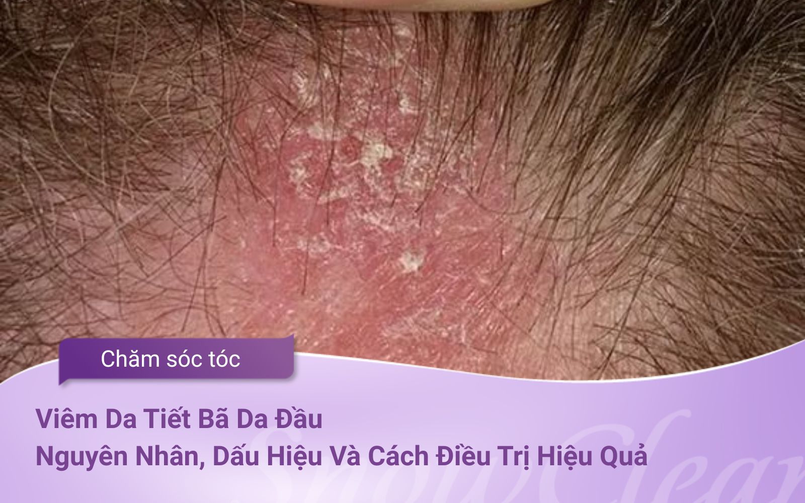 Viêm Da Tiết Bã Da Đầu Nguyên Nhân, Dấu Hiệu Và Cách Điều Trị Hiệu Quả