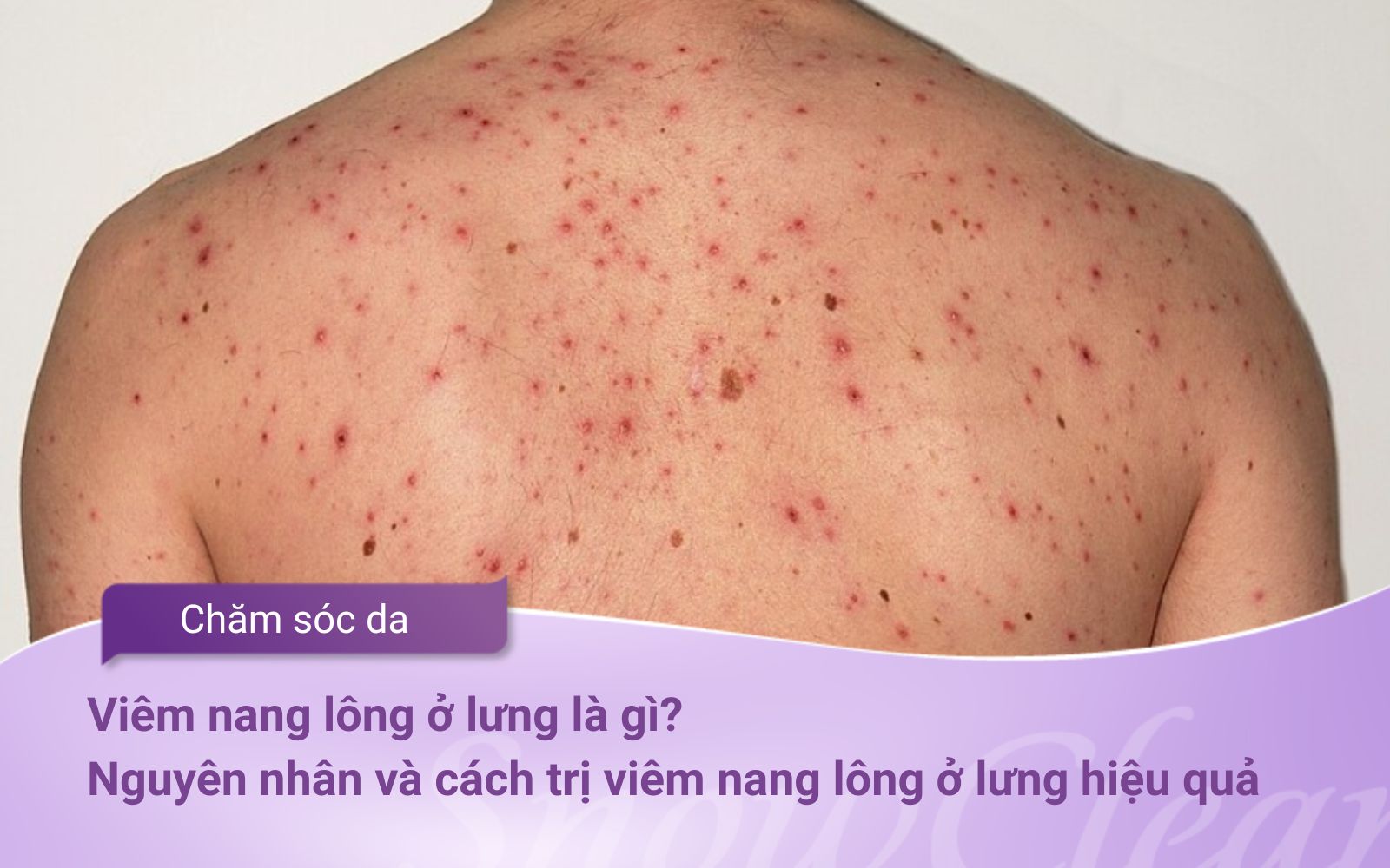 Viêm nang lông ở lưng là gì? Nguyên nhân và cách trị viêm nang lông ở lưng hiệu quả
