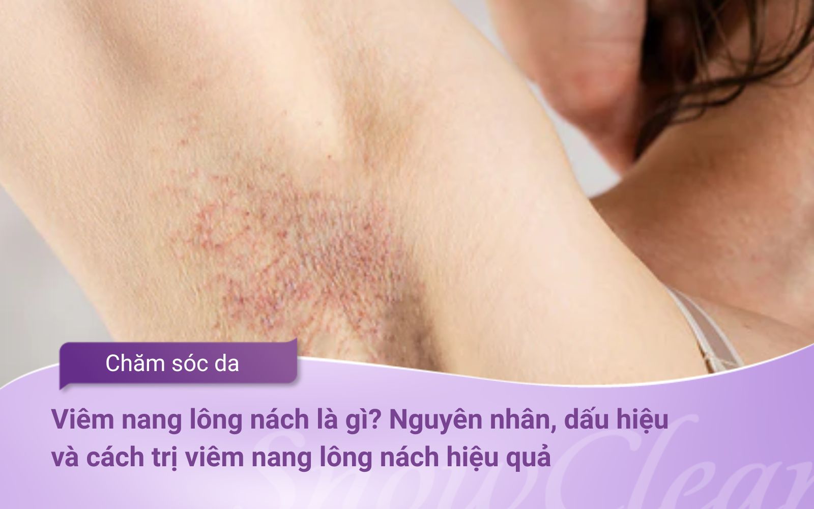 Viêm nang lông nách là gì? Nguyên nhân, dấu hiệu và cách trị viêm nang lông nách hiệu quả