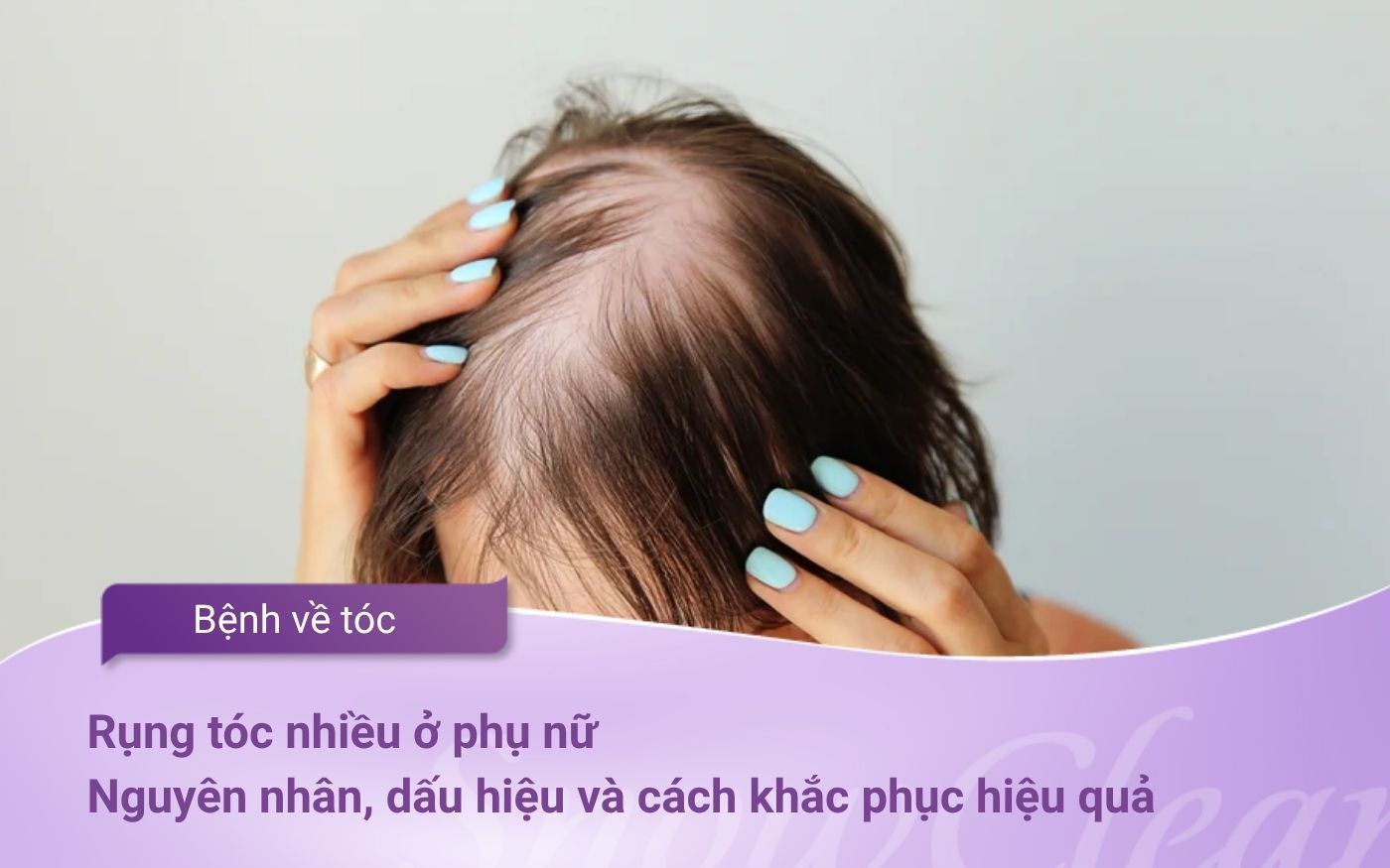 Rụng tóc nhiều ở phụ nữ  Nguyên nhân, dấu hiệu và cách khắc phục hiệu quả