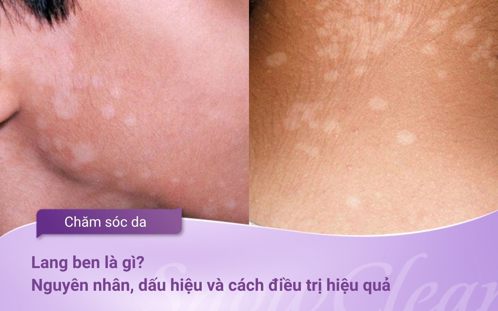Lang ben là gì? Nguyên nhân, dấu hiệu và cách điều trị hiệu quả