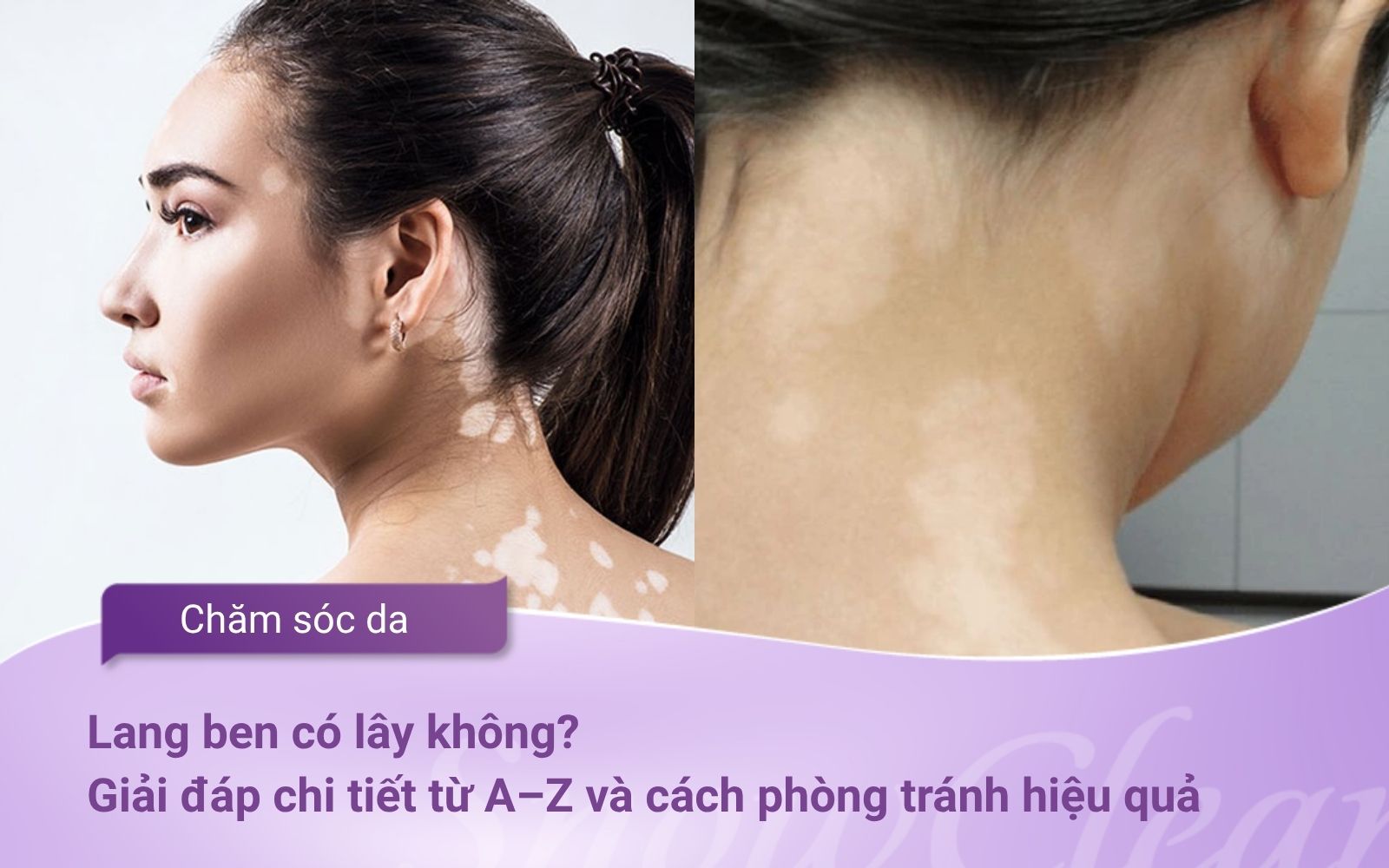 Lang ben có lây không? Giải đáp chi tiết từ A–Z và cách phòng tránh hiệu quả