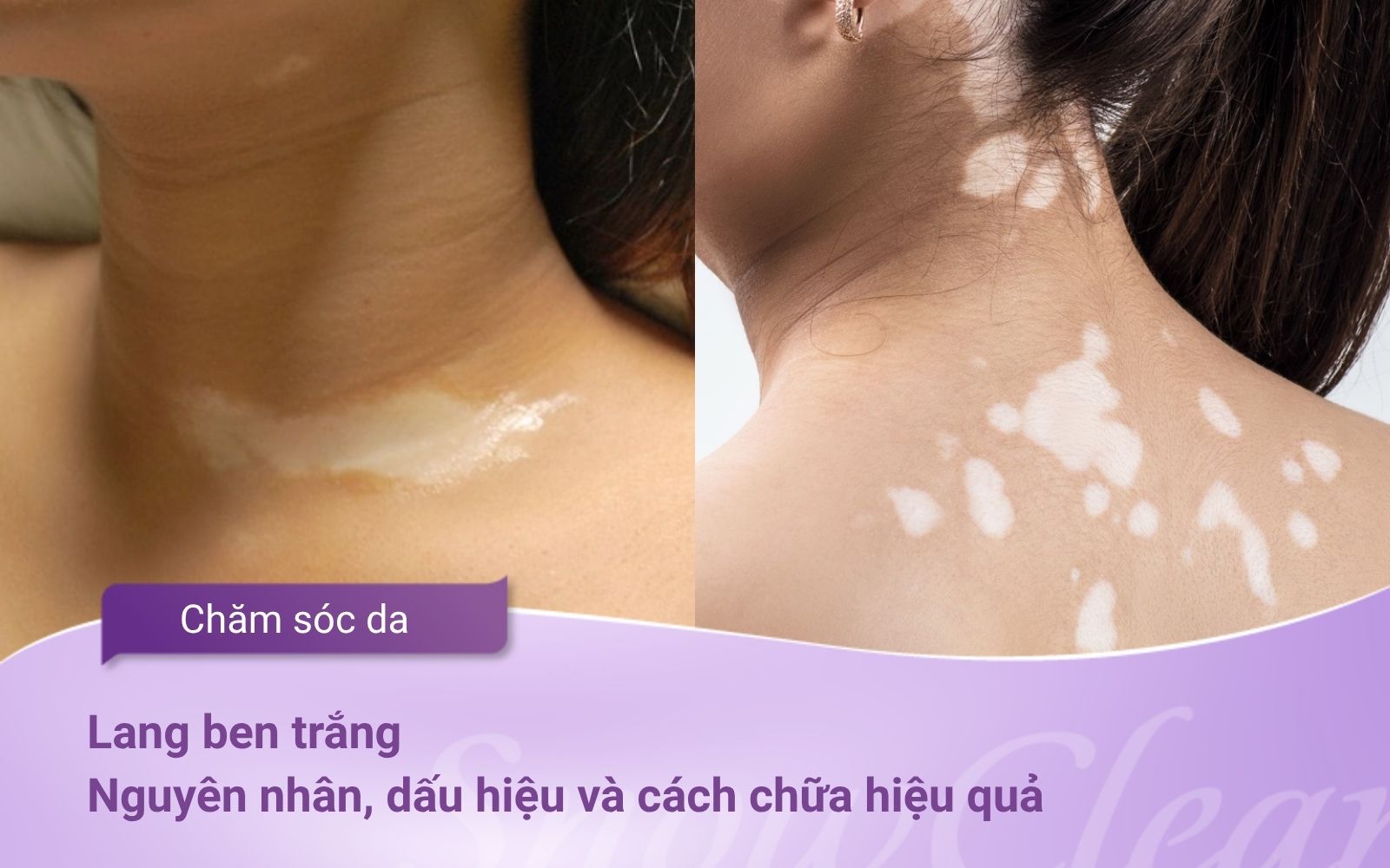 Lang ben trắng: Nguyên nhân, dấu hiệu và cách chữa hiệu quả từ A–Z