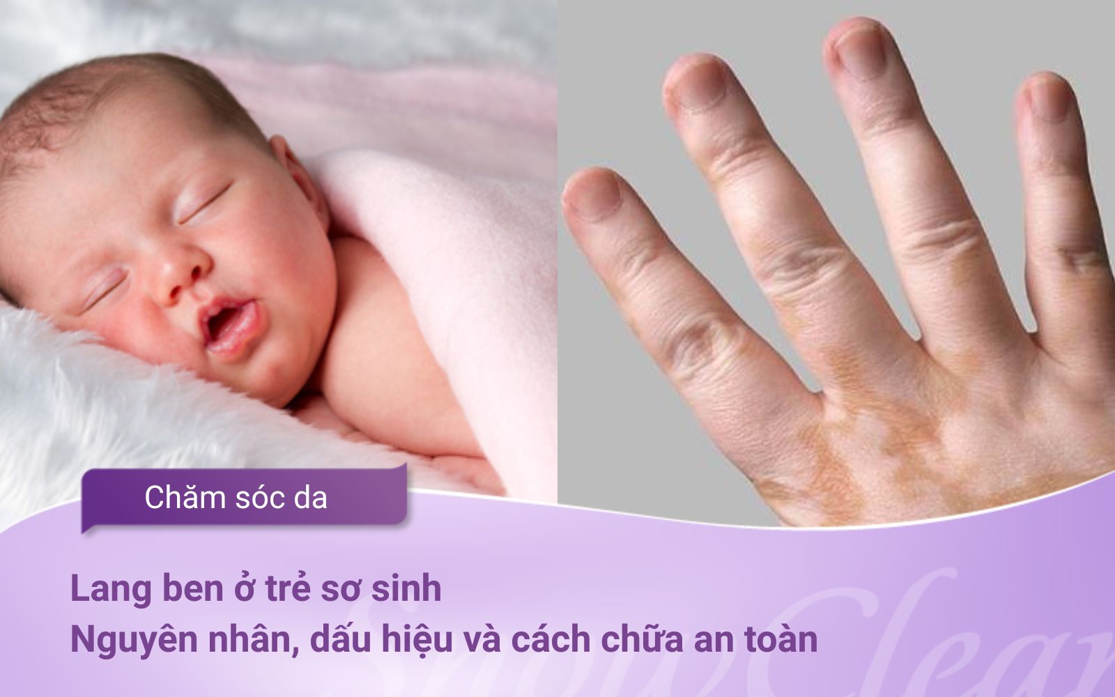 Lang ben ở trẻ sơ sinh: Nguyên nhân, dấu hiệu và cách chữa an toàn