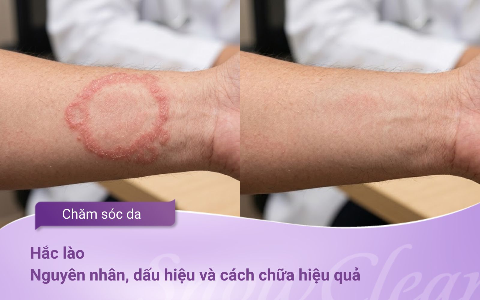 Hắc lào: Nguyên nhân, dấu hiệu và cách chữa hiệu quả