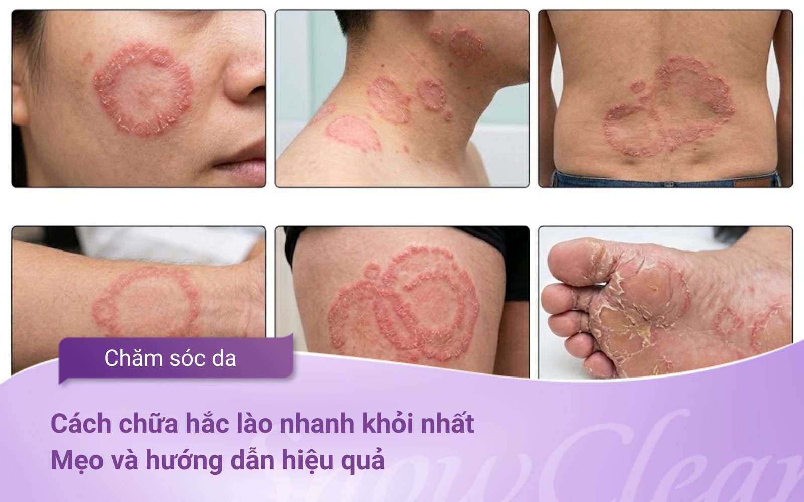 Cách chữa hắc lào nhanh khỏi nhất: Mẹo và hướng dẫn hiệu quả