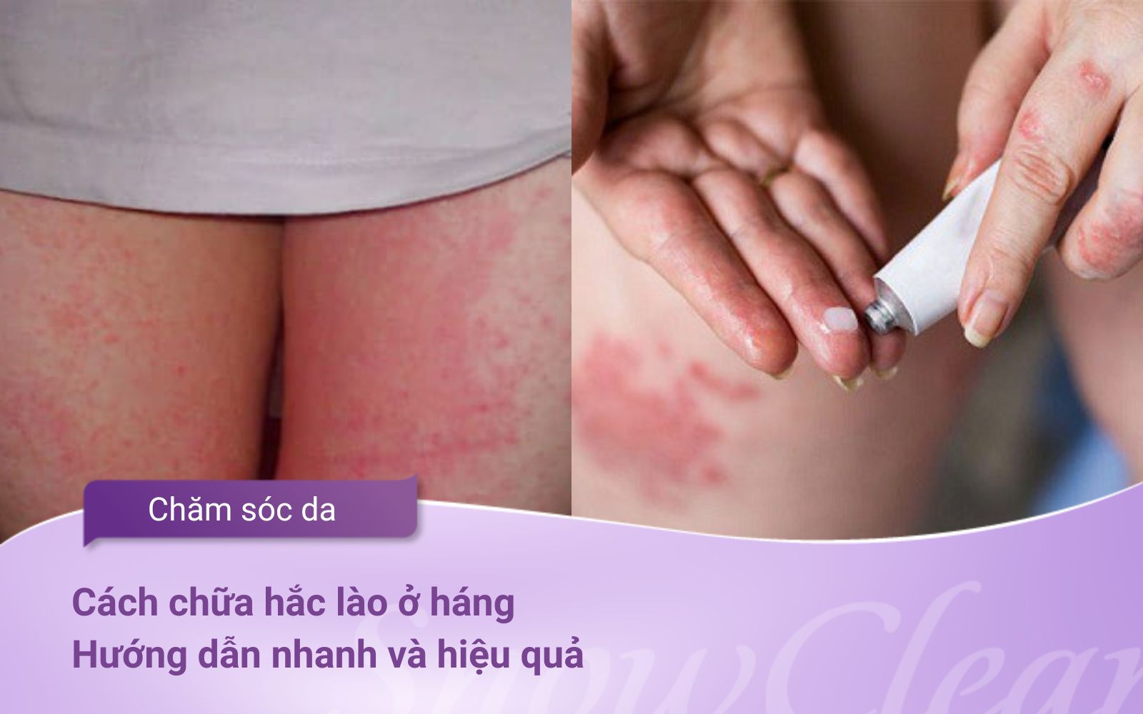 Cách chữa hắc lào ở háng: Hướng dẫn nhanh và hiệu quả