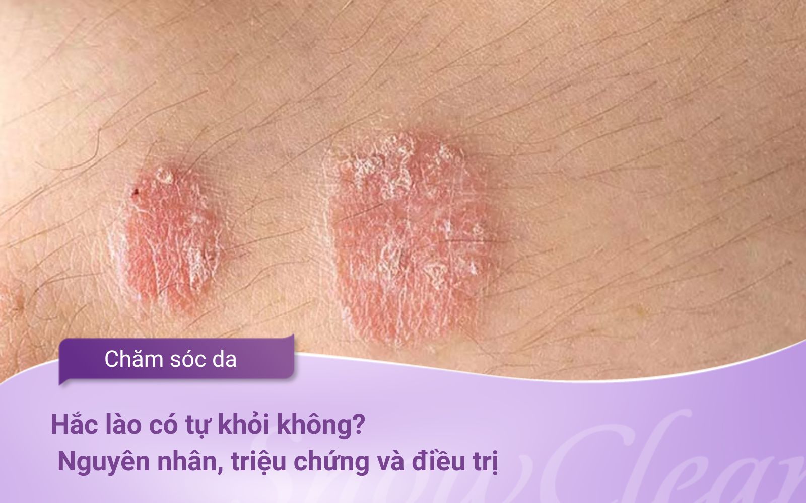 Hắc lào có tự khỏi không? Nguyên nhân, triệu chứng và điều trị