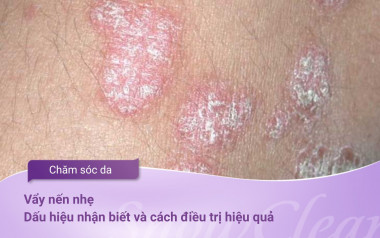 Vẩy nến nhẹ Dấu hiệu nhận biết v&agrave; c&aacute;ch điều trị hiệu quả
