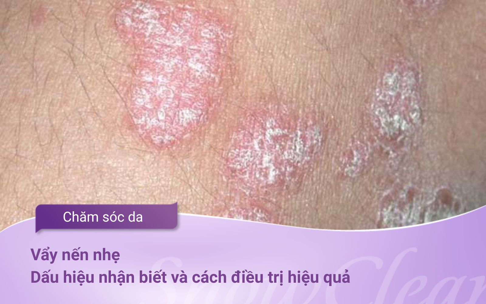 Vẩy nến nhẹ Dấu hiệu nhận biết và cách điều trị hiệu quả