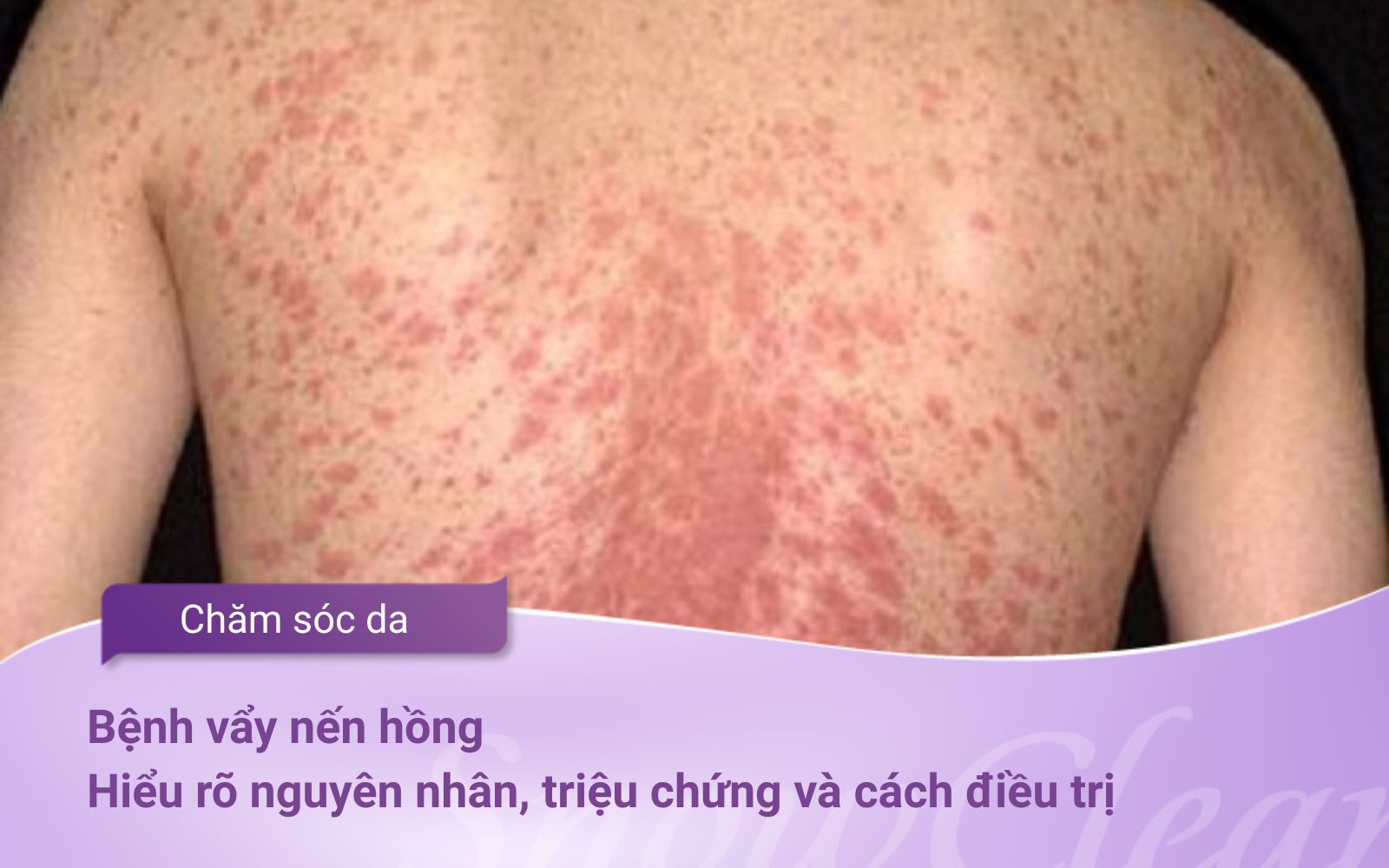 Bệnh vẩy nến hồng: Hiểu rõ nguyên nhân, triệu chứng và cách điều trị