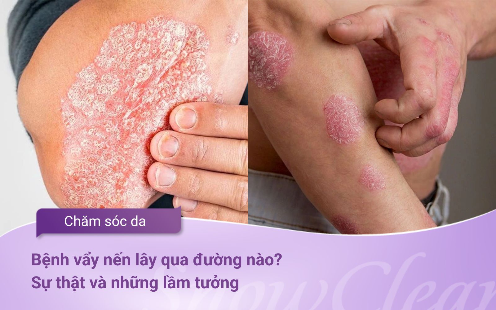 Bệnh vẩy nến lây qua đường nào? Sự thật và những lầm tưởng