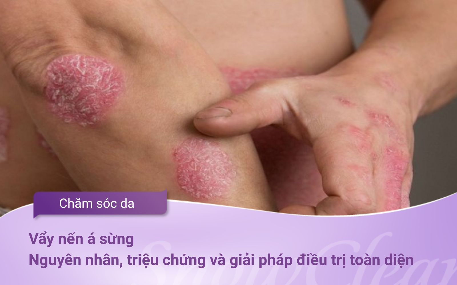 Vẩy nến á sừng: Nguyên nhân, triệu chứng và giải pháp điều trị toàn diện