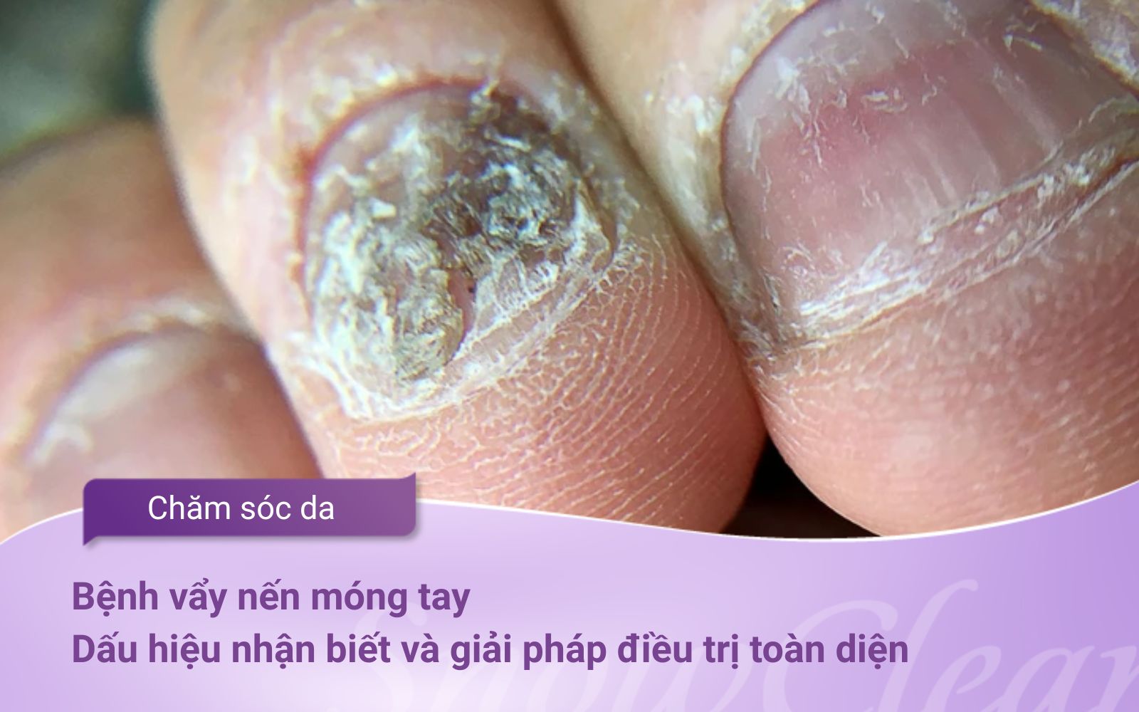 Bệnh vẩy nến móng tay: Dấu hiệu nhận biết và giải pháp điều trị toàn diện
