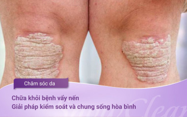 Chữa khỏi bệnh vẩy nến: Giải pháp kiểm soát và chung sống hòa bình