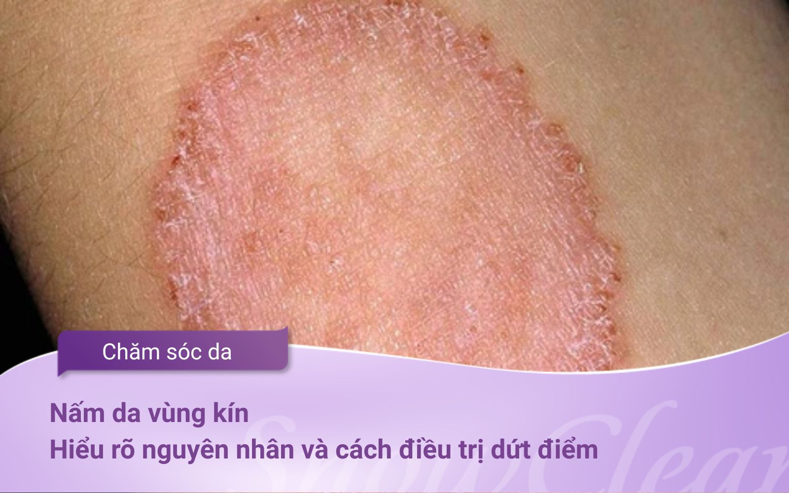 Nấm da vùng kín: Hiểu rõ nguyên nhân và cách điều trị dứt điểm