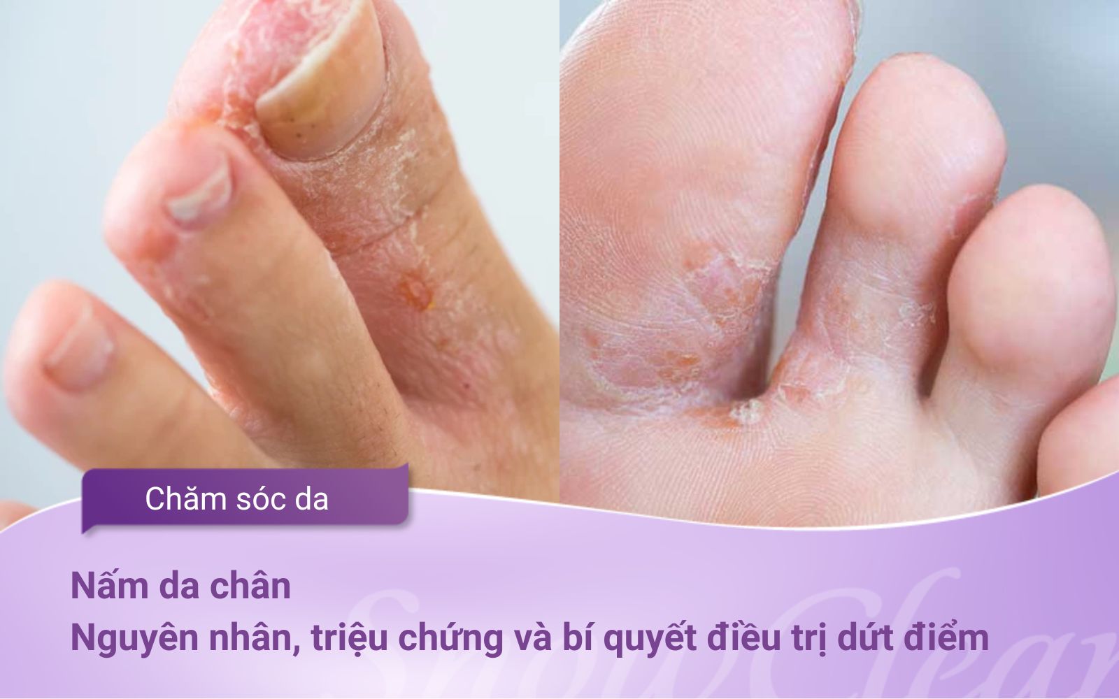 Nấm da chân: Nguyên nhân, triệu chứng và bí quyết điều trị dứt điểm
